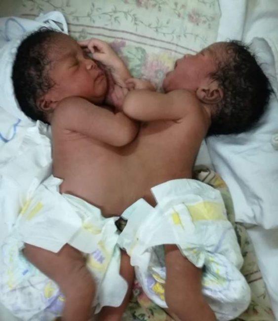 oy as Nigeria doctors separate conjoined twins