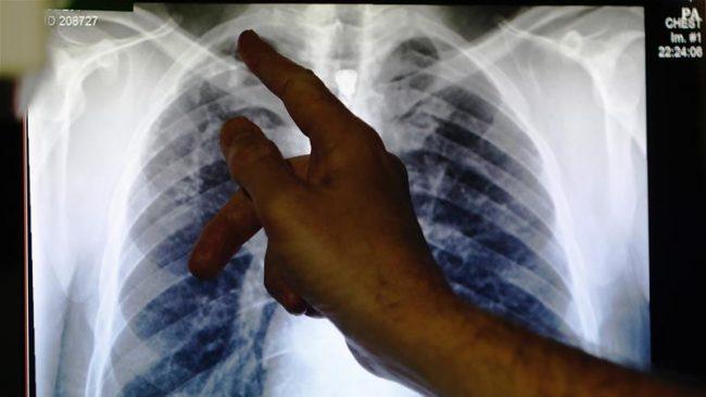 A doctor points to an x-ray showing a pair of lungs [File: Reuters]