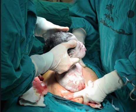 Rising Caesarean section rates suggest increase in unnecessary procedures – WHO