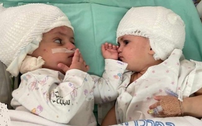 Year-old twin sisters see each other for the first time after rare surgery
