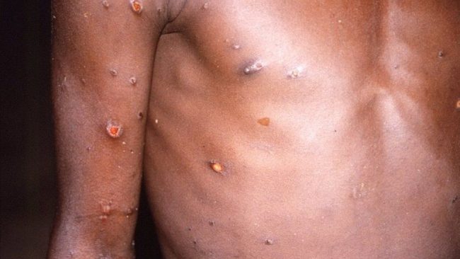 80 cases of monkey pox confirmed in 12 countries