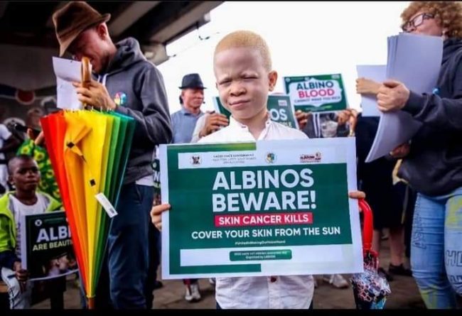Lagos disability affairs office celebrates International Albinism Day