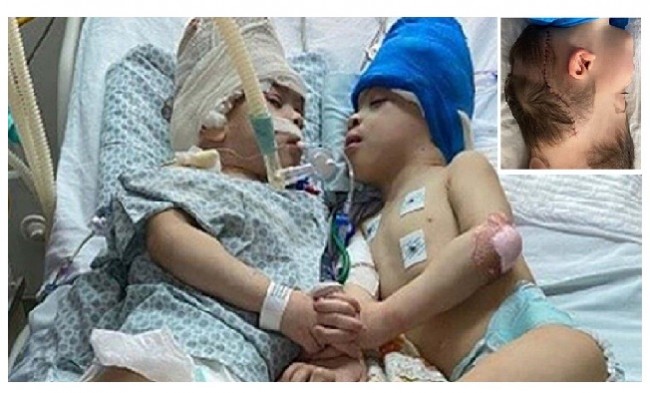 Doctors separate conjoined Brazilian twins with virtual reality help