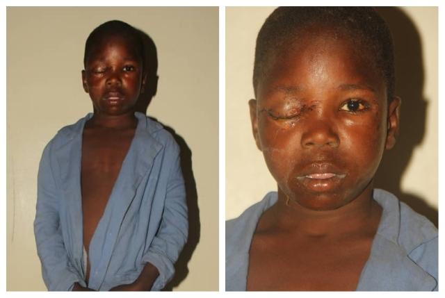 Police investigate removal of boy's eye in Bauchi
