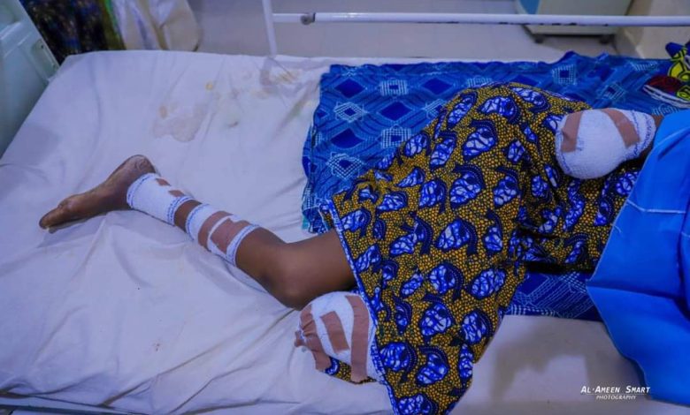 17-year-old girl loses limbs after attack by husband