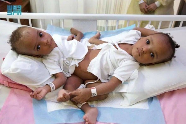 Saudi surgeons separate Kaduna-born conjoined twins after 14-hour operation