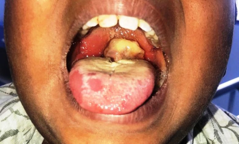 UNICEF raises alarm over 'unprecedented diphtheria outbreak', deploys 9.3m doses vaccines to 7 states