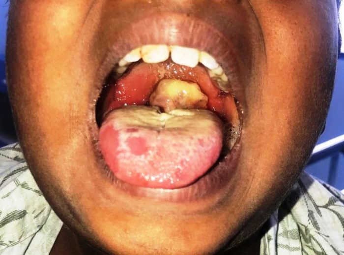 UNICEF raises alarm over 'unprecedented diphtheria outbreak', deploys 9.3m doses vaccines to 7 states