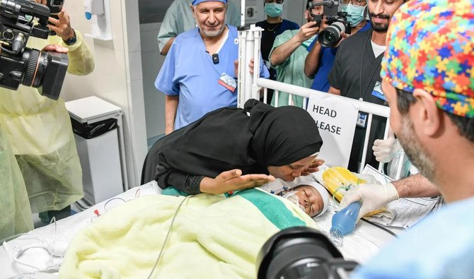 Saudi doctors separate Tanzanian conjoined twins