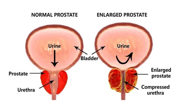 What are the symptoms of an enlarged prostate and how is it treated?